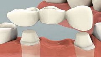 Everything you must know about Crowns and Bridges: Because Your Smile matters!