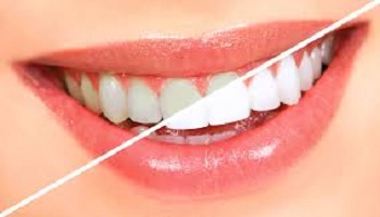 Teeth Bleaching – How Teeth Bleaching Can Help You Get Your White Smile Back?