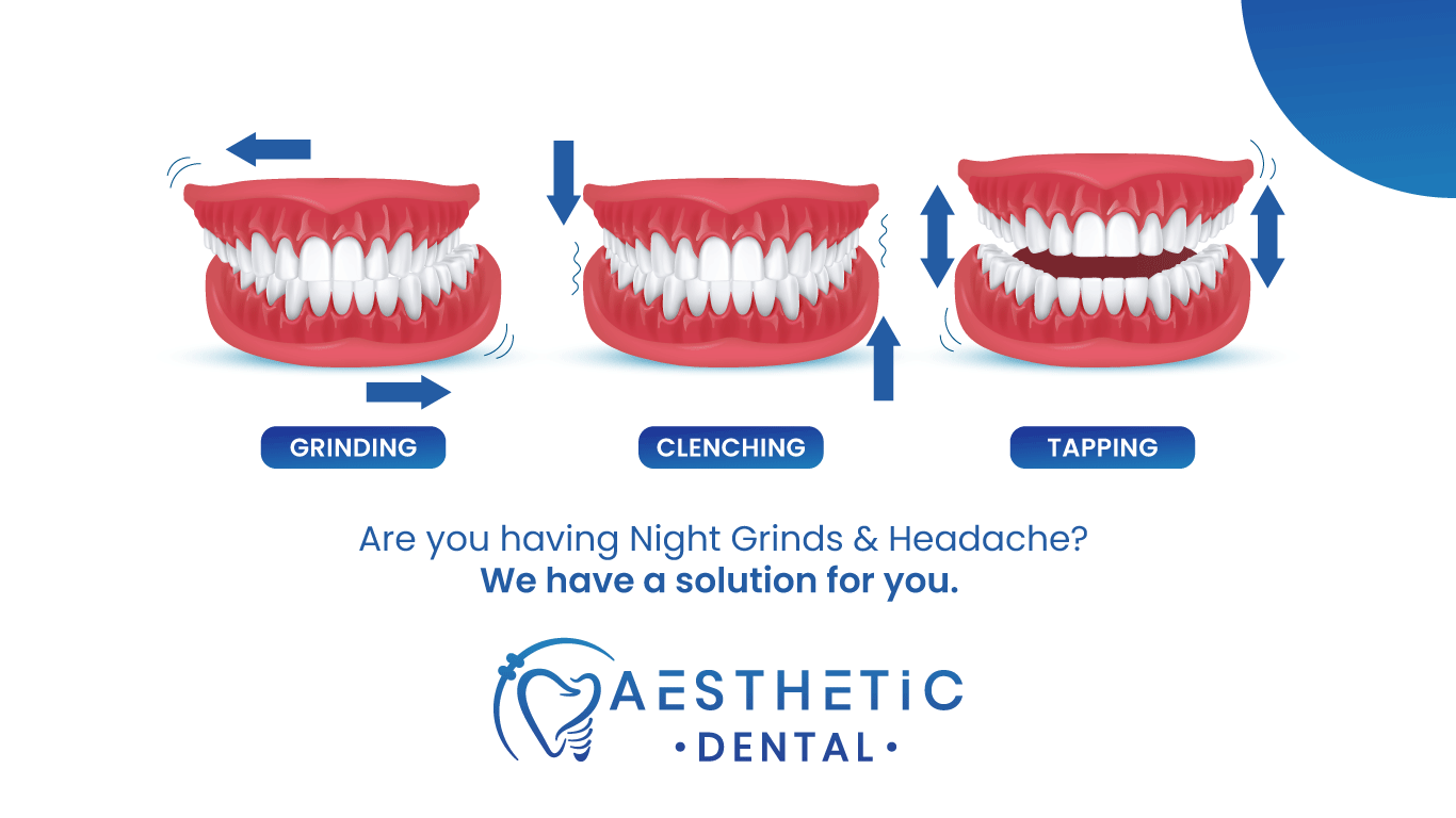 Dental Bruxism (Teeth Grinding) - Causes, Symptoms & Treatment