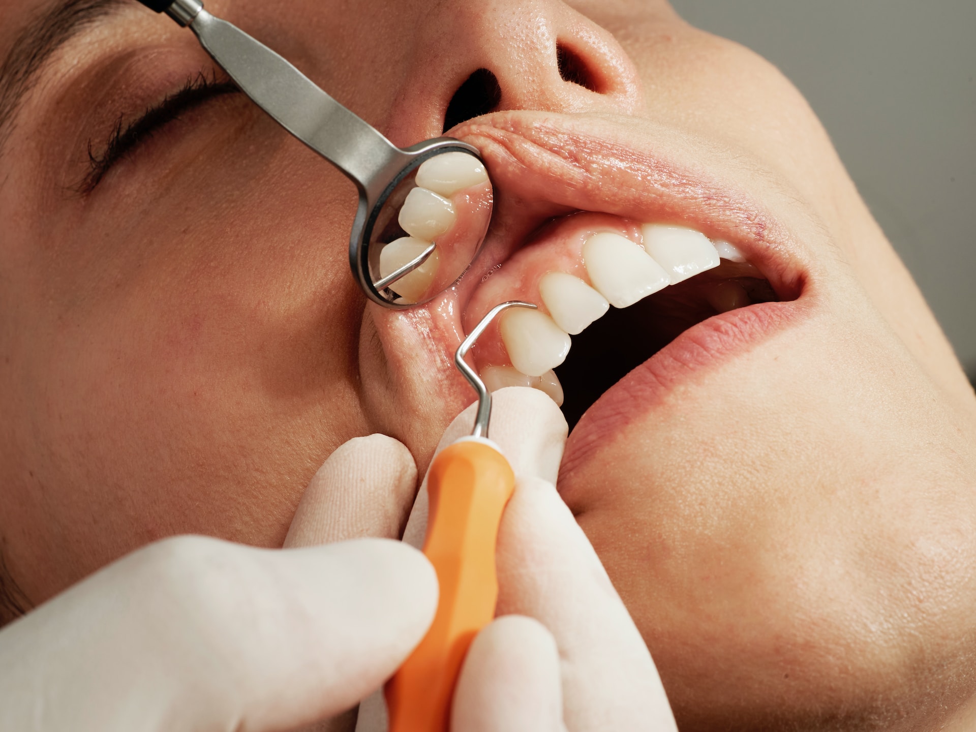 Dental Scaling or Cleaning: 8 Common Myths and Facts you must know about