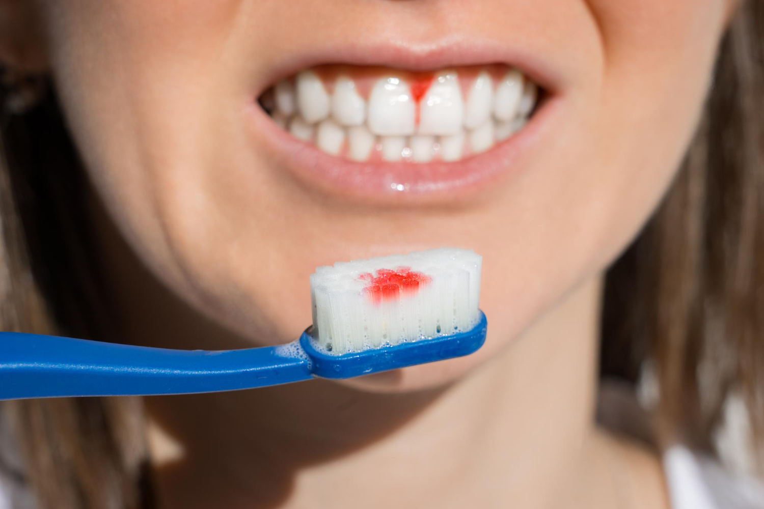 Bleeding Gums: Understanding Causes and ways to Cure