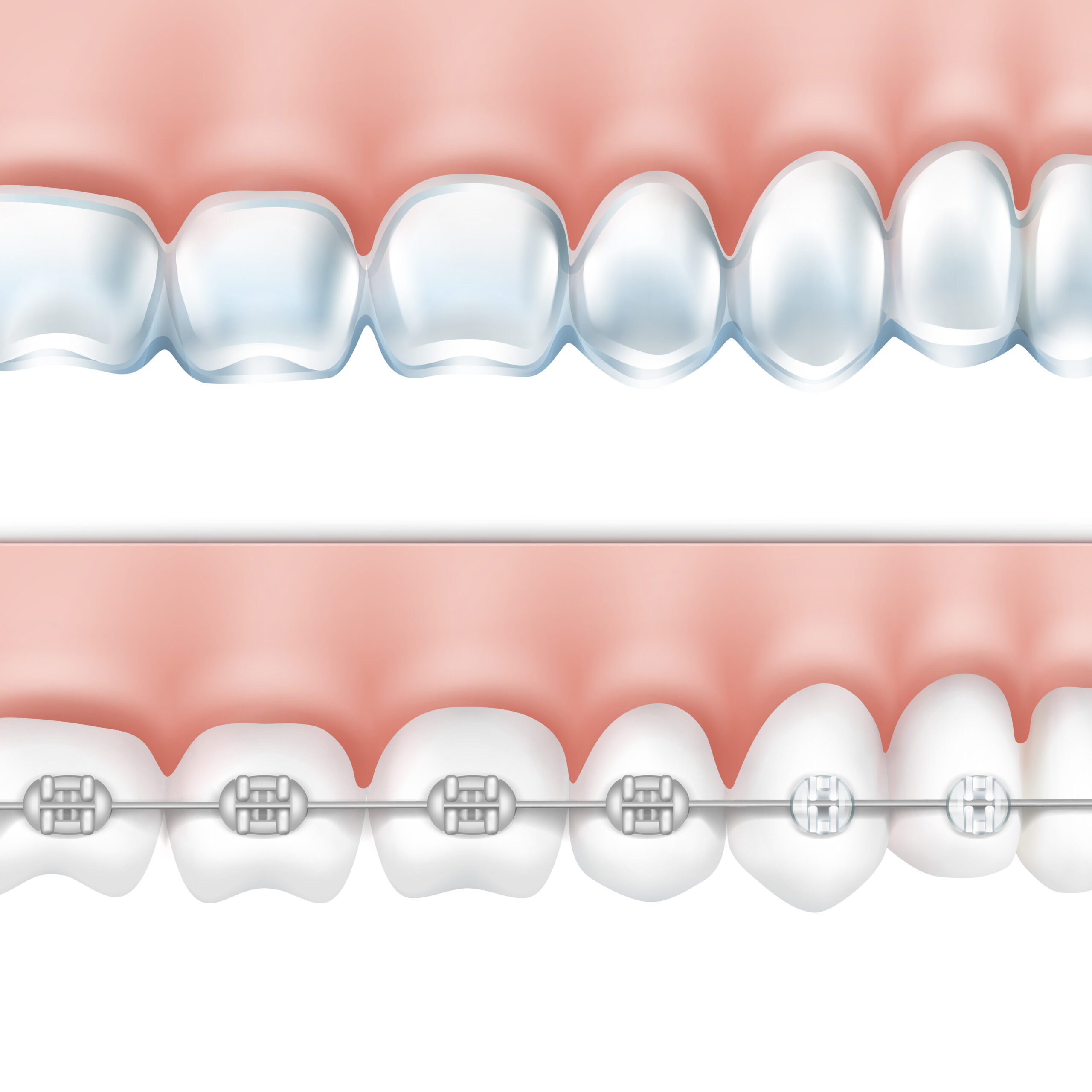 invisalign vs braces