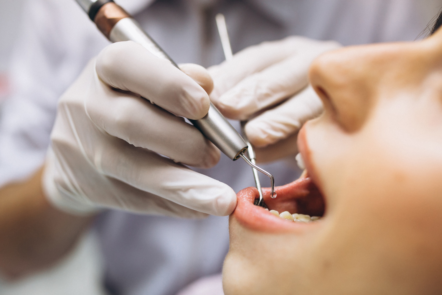 Debunking 10 Popular Myths About Root Canal: The Truth Revealed