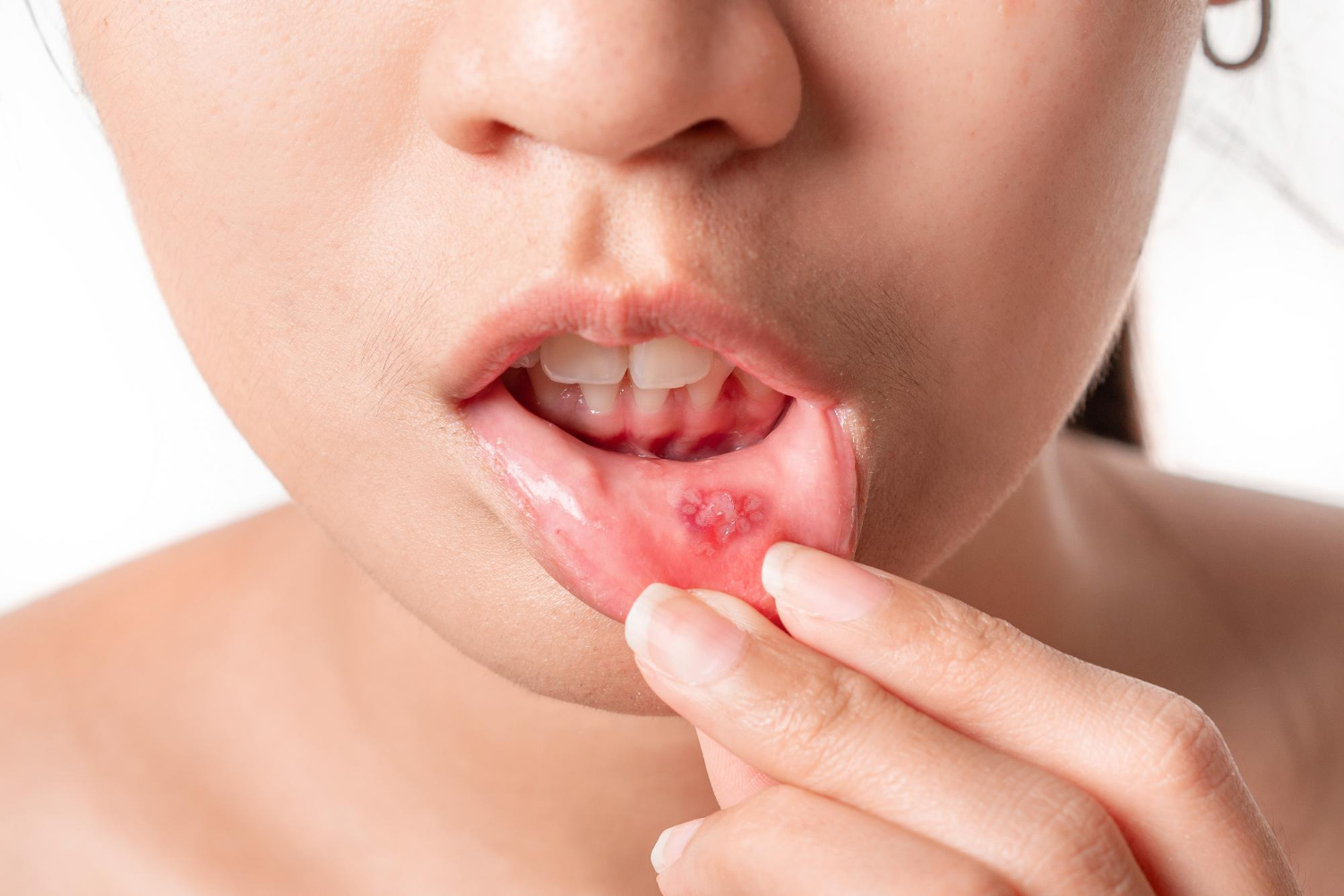 A Complete Guide on Mouth Ulcers: Causes, Symptoms and Treatment