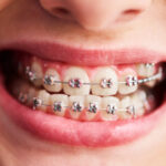 damon braces and traditional braces