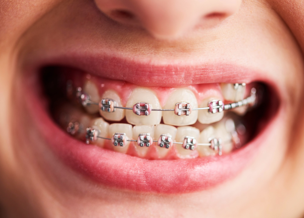 Damon Braces and Traditional Braces: 5 Key Points to Choose the Best for You